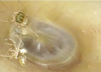 64 හැවිරිදි කාන්තාවකගේ කනේ දින හතරක් තිස්සේ මකුළුවෙක්